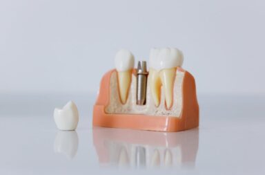 dental bridge